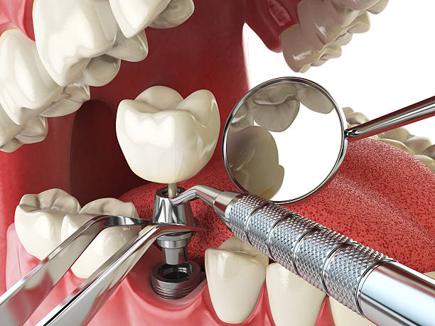 Best Emergency Denture Repair in Zolfo Springs, FL